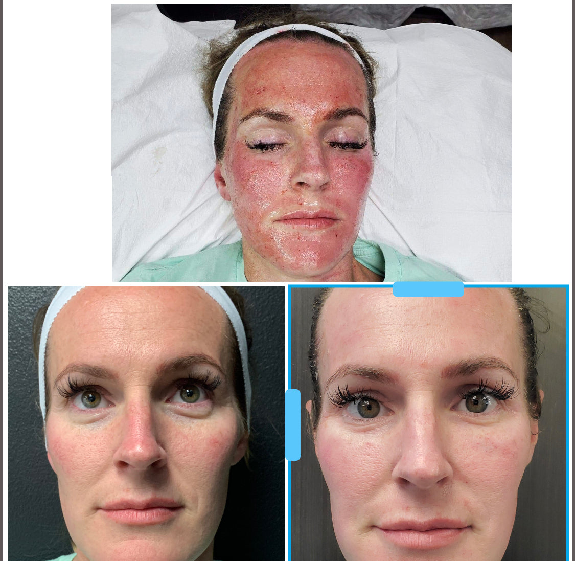 CO2Lift Pro - 3 masker - Kurforløb