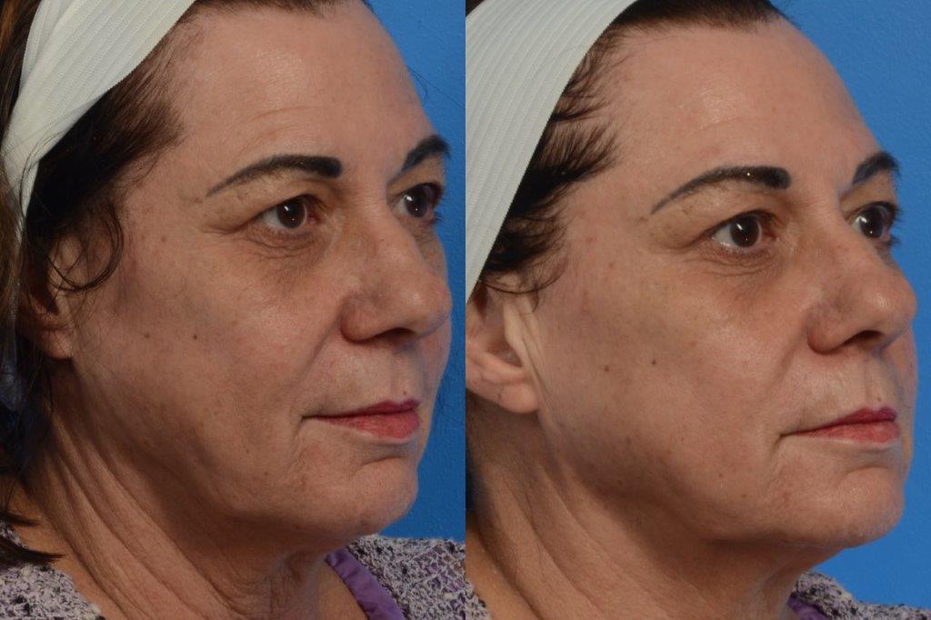 CO2Lift Pro behandling